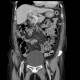 Edema of mesenteric fat in anasarca: CT - Computed tomography